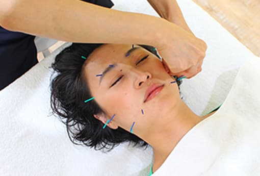 美容鍼施術1